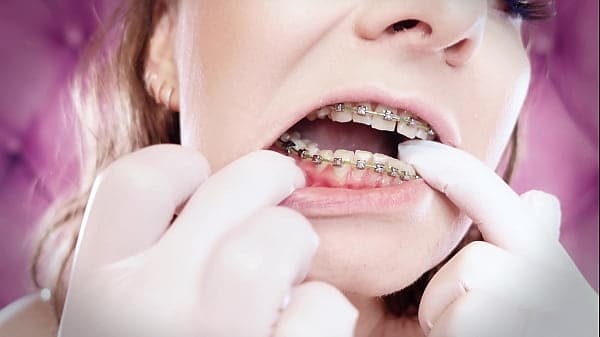 ASMR: upgraded braces with chain-link rubber bands and nitrile gloves
